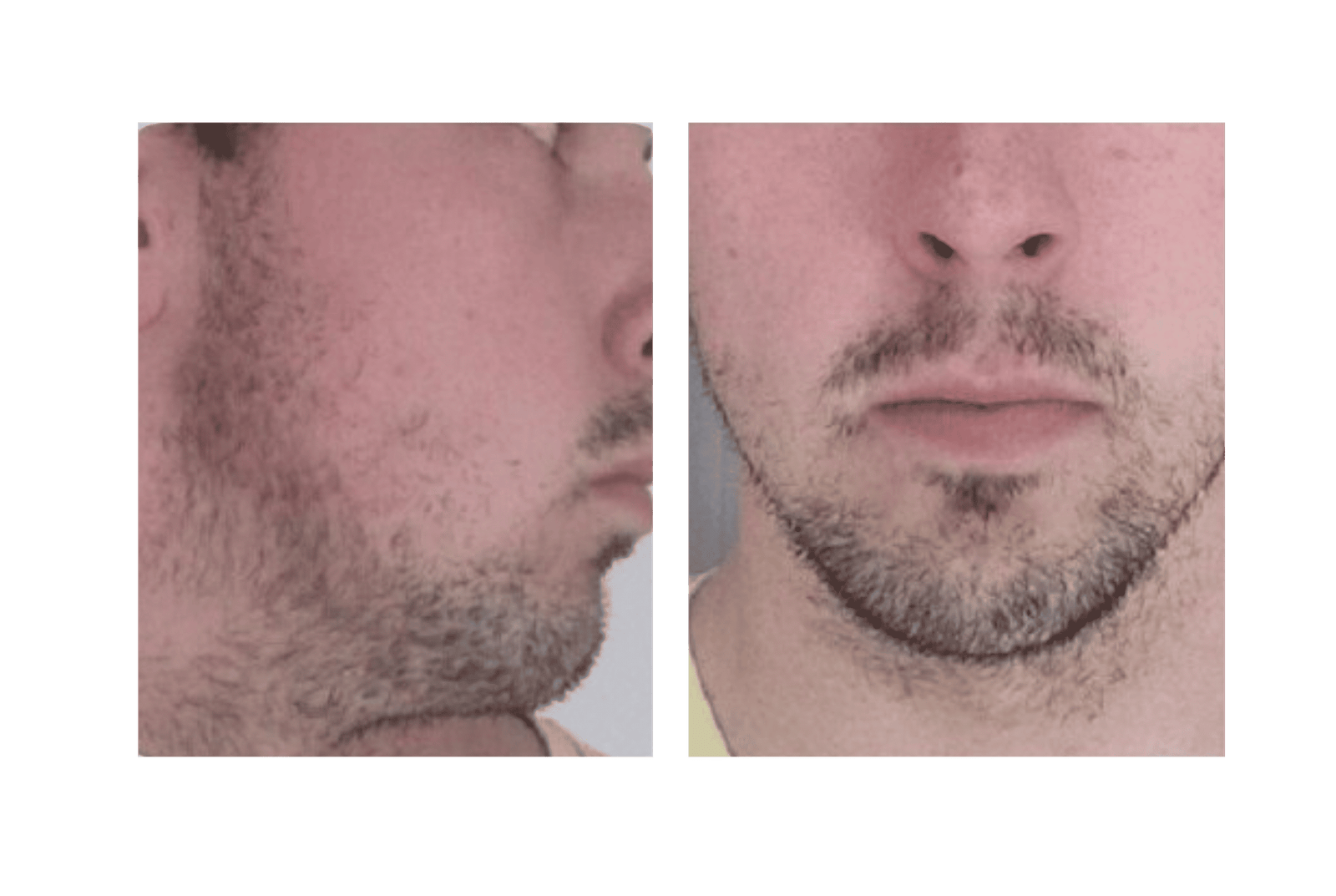 Barba Antes de Minoxidil Kirkland - Día 1 y Semana 1 Argentina