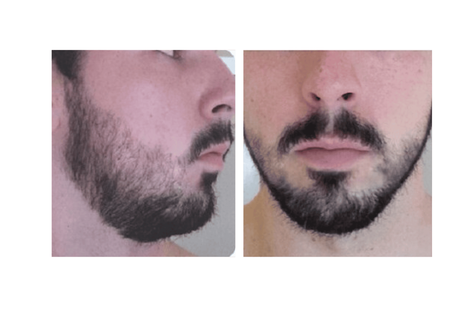 Barba Después de Minoxidil Kirkland - Mes 4 a 6 Argentina